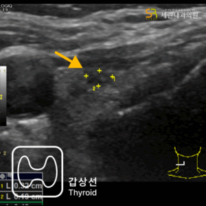 무증상 검진 중 갑상선초음파로 발견된 조기 갑상선 유두암 사례