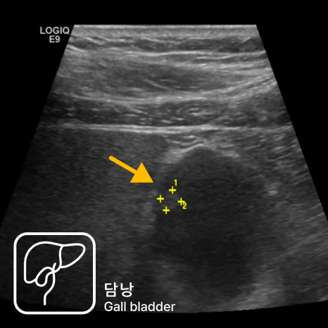세란_복부초음파_담낭_1 (1)