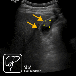 속쓰림으로 내원했다가 복부초음파로 조기 담낭암을 발견한 사례