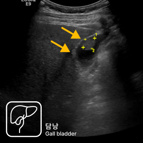 속쓰림으로 내원했다가 복부초음파로 조기 담낭암을 발견한 사례