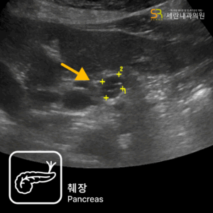 명치 통증과 소화불량으로 내원했다가 췌장암 3기가 진단된 사례