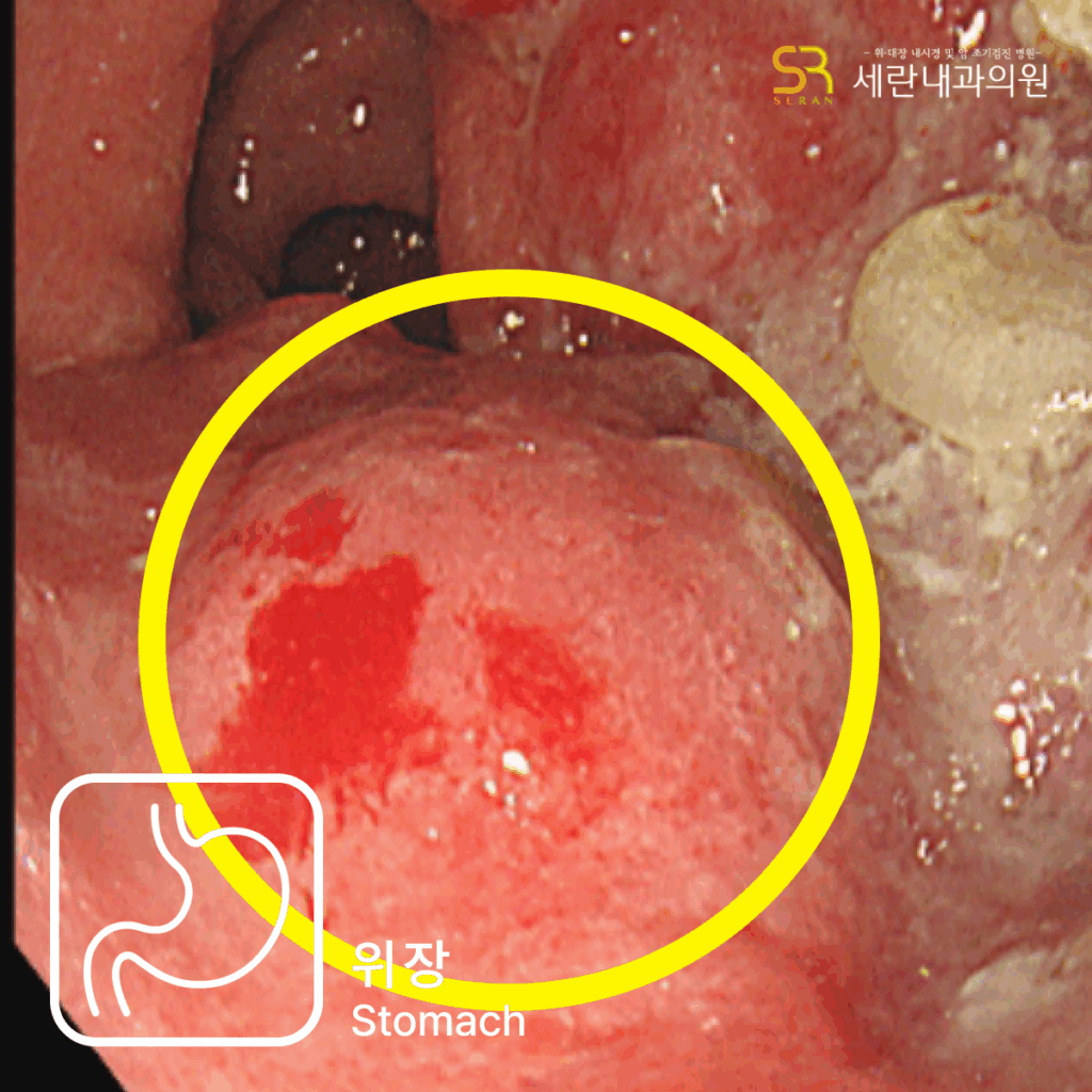 소화불량으로 내원했다가 진행성 위암을 발견한 60대 여성 사례