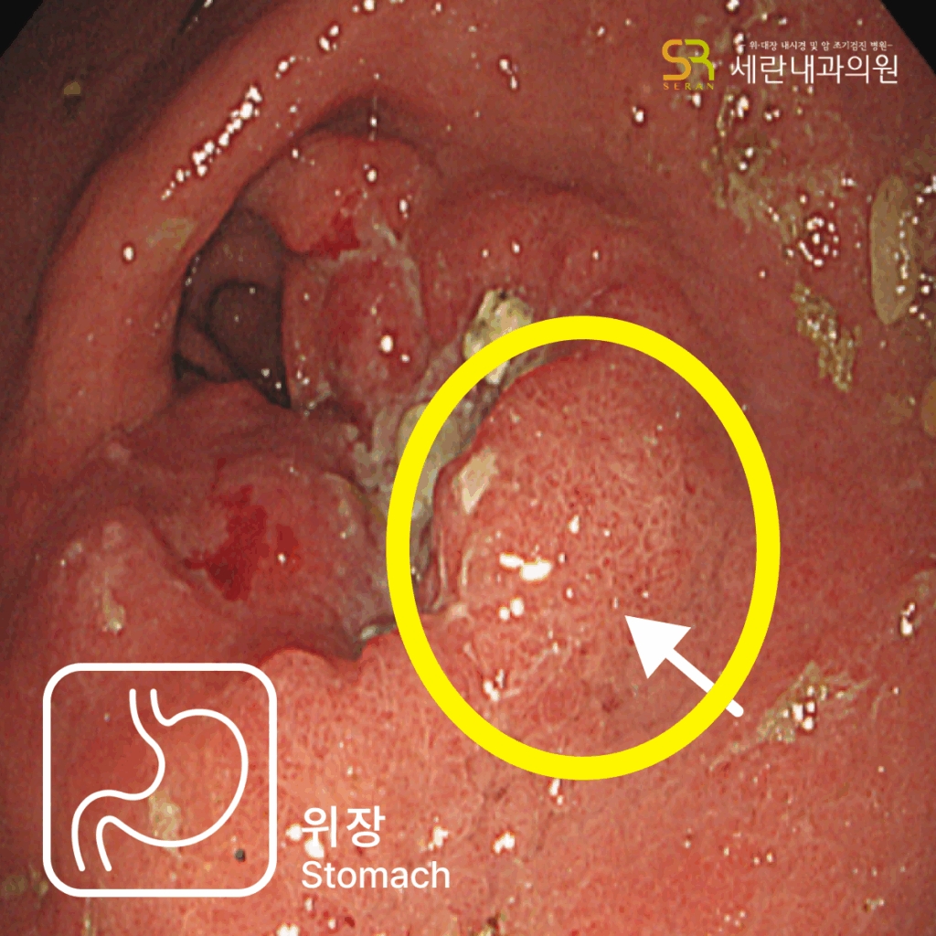 전정부에서 관찰된 궤양성 종괴