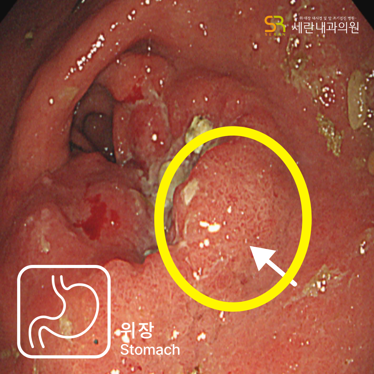 전정부에서 관찰된 궤양성 종괴