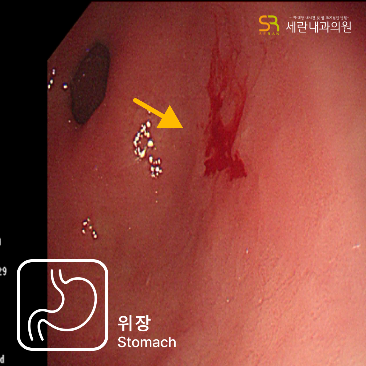 위내시경 결과