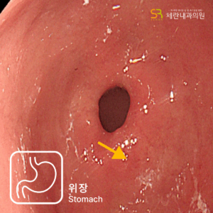경미한 속쓰림으로 방문했다가 조기 위선암을 발견한 60대 여성 사례