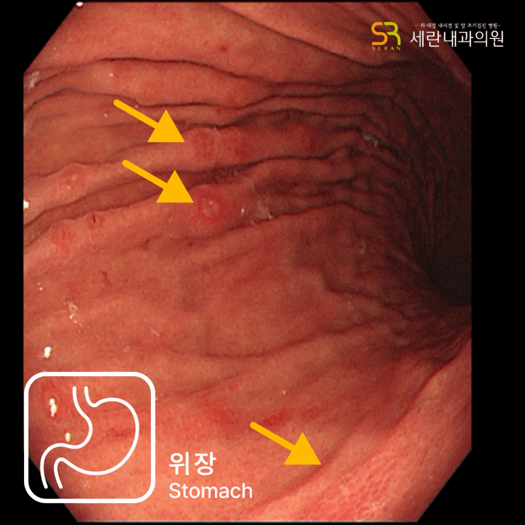 위체부에 관찰된 다발성 위미란