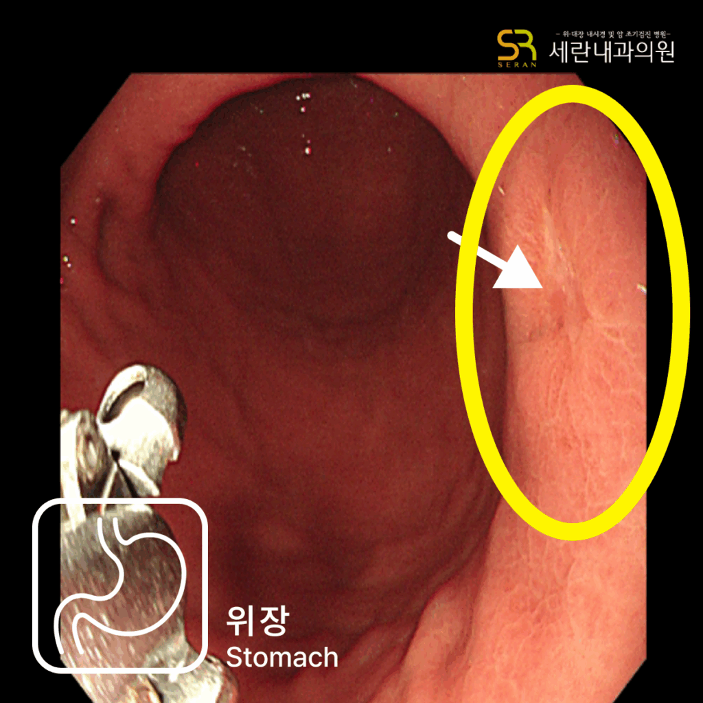 속쓰림으로 내원했다가 signet ring cell type 위암을 조기 발견한 60대 여성 사례