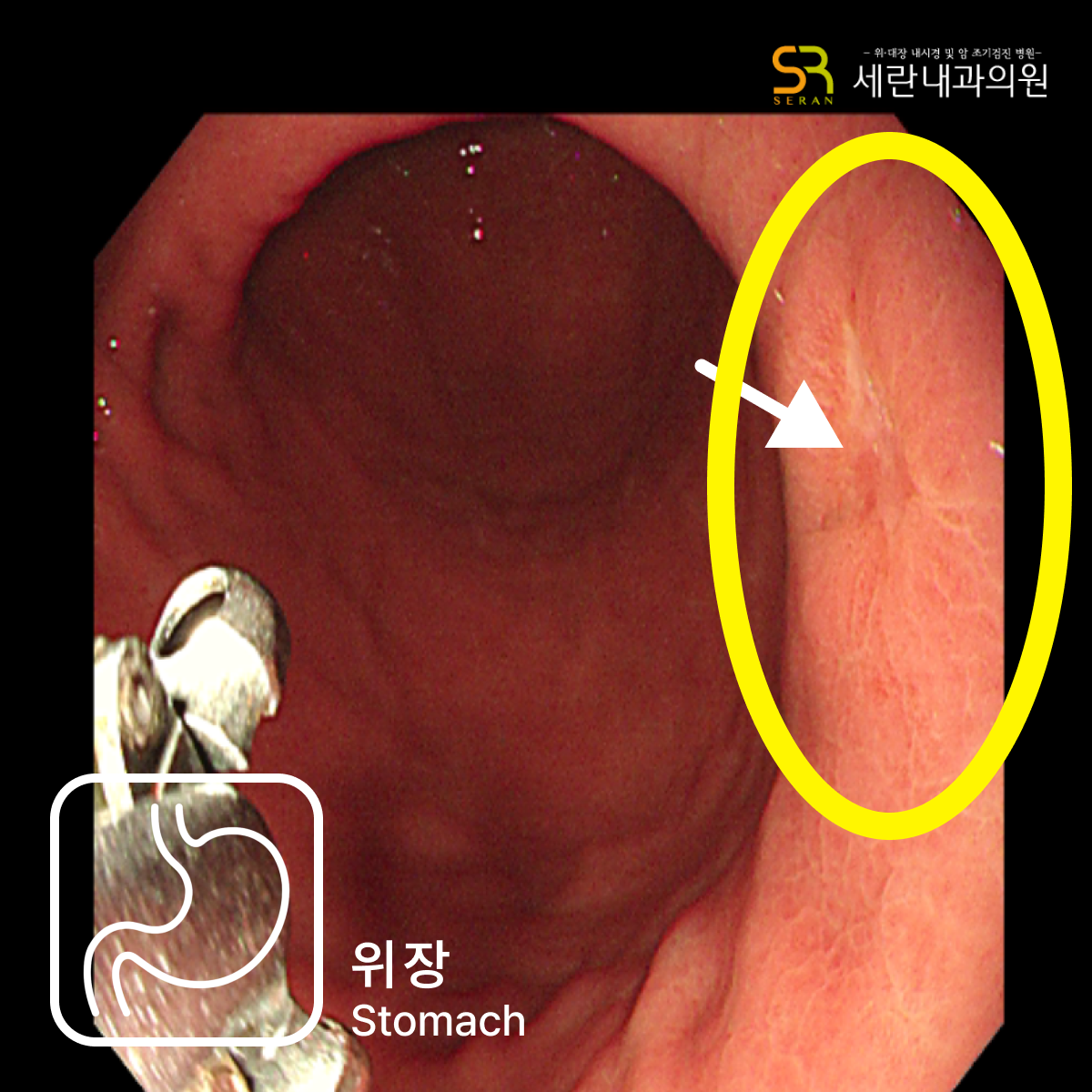 비정형 궤양 형태 병변