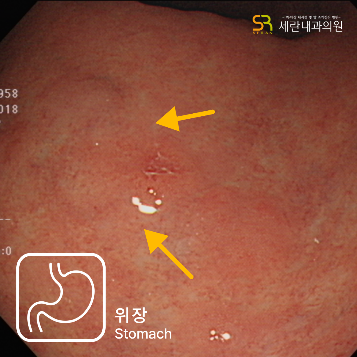작은 미란