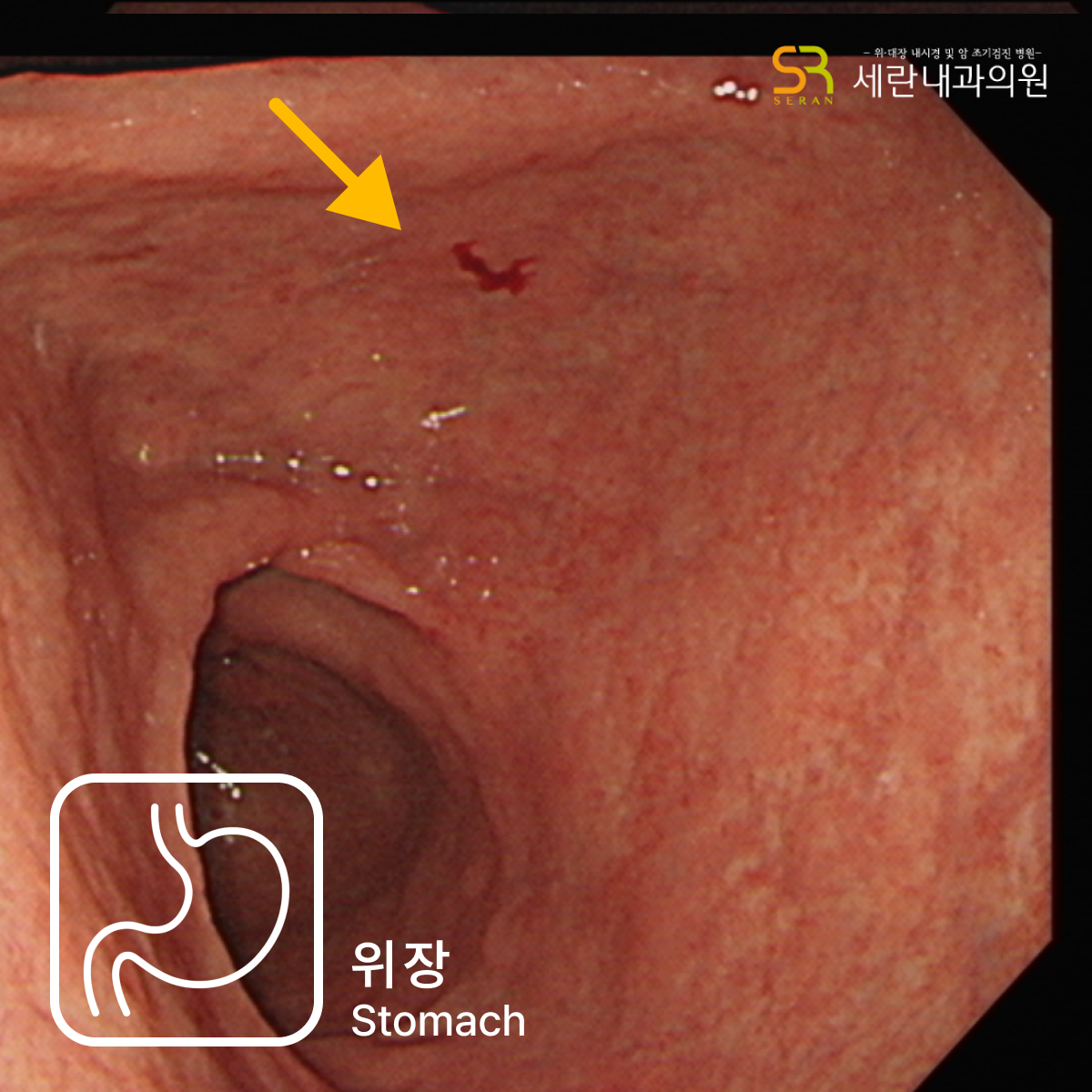 위암이 의심된 부위 제거된 상태