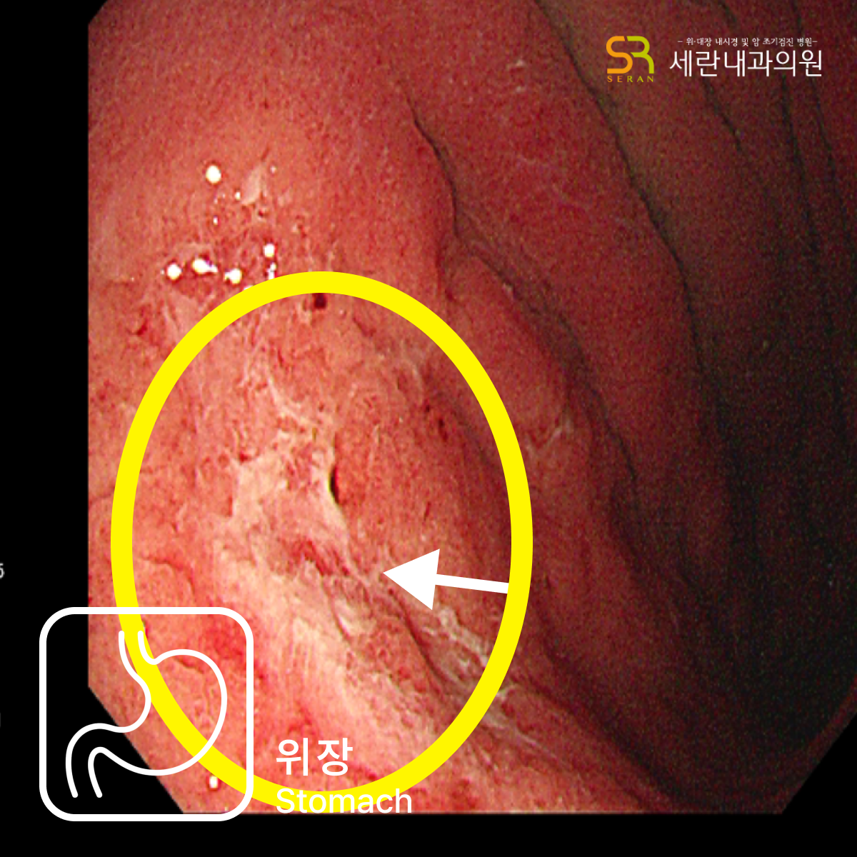 위체부 후벽에 궤양성 변화