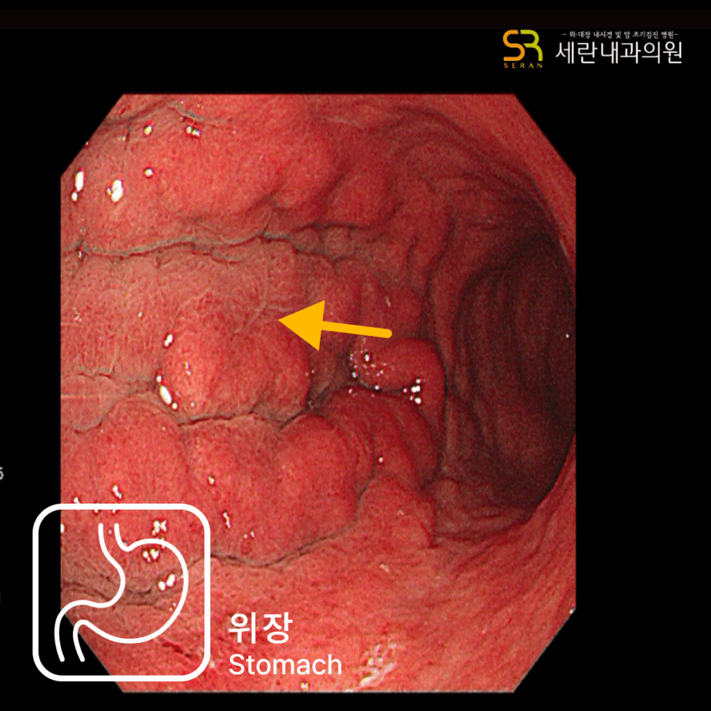 위점막의 발적과 부종