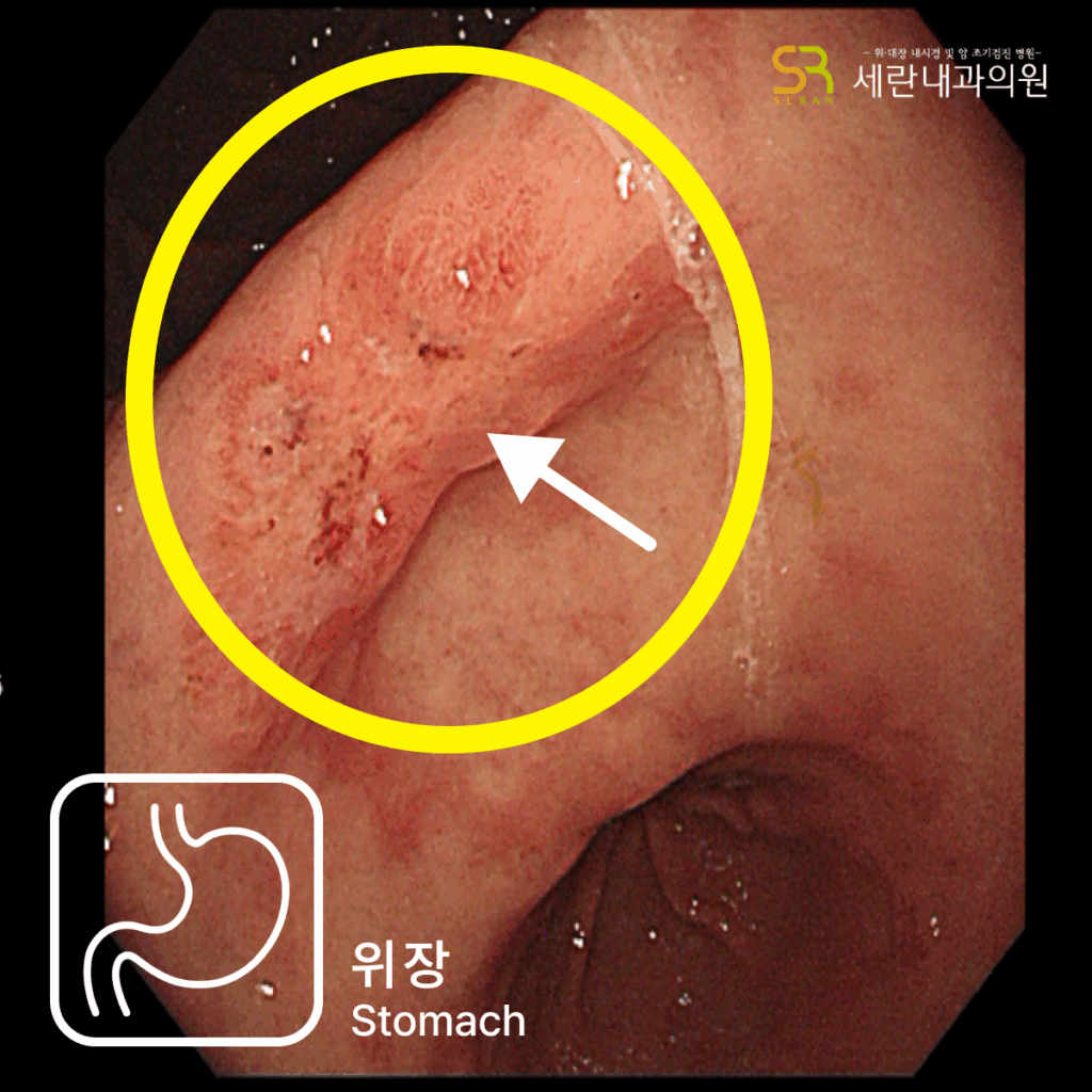 변비로 내원했다가 침윤성 궤양 형태의 위암을 발견한 70대 여성 사례
