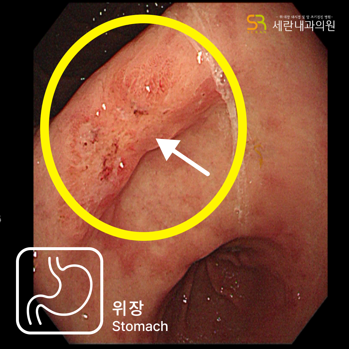 침윤성 궤양 병변