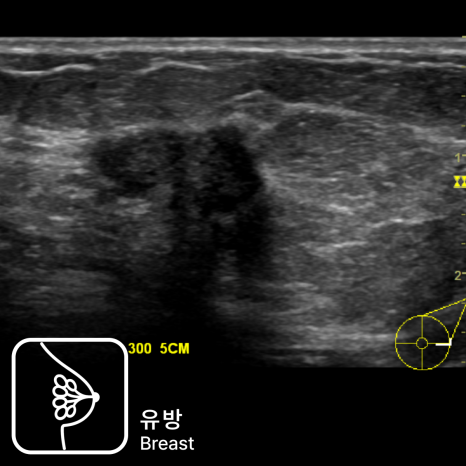 세란_유방초음파_검사결과-1