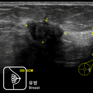유방 통증으로 내원했다가 유방초음파로 조기 진단된 침윤성 유방암 사례