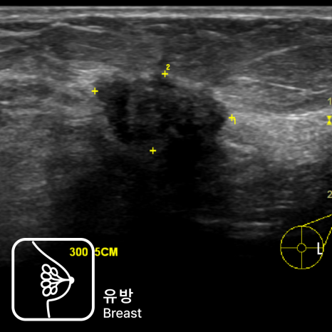 유방 통증으로 내원했다가 유방초음파로 조기 진단된 침윤성 유방암 사례