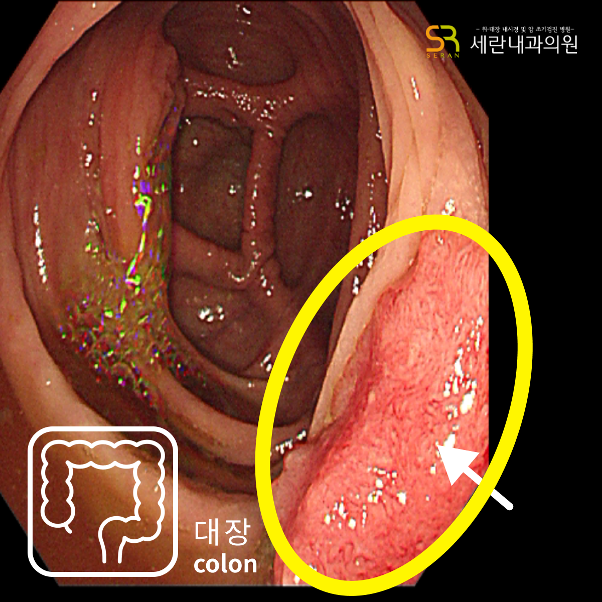 대장에서 발견된 용종