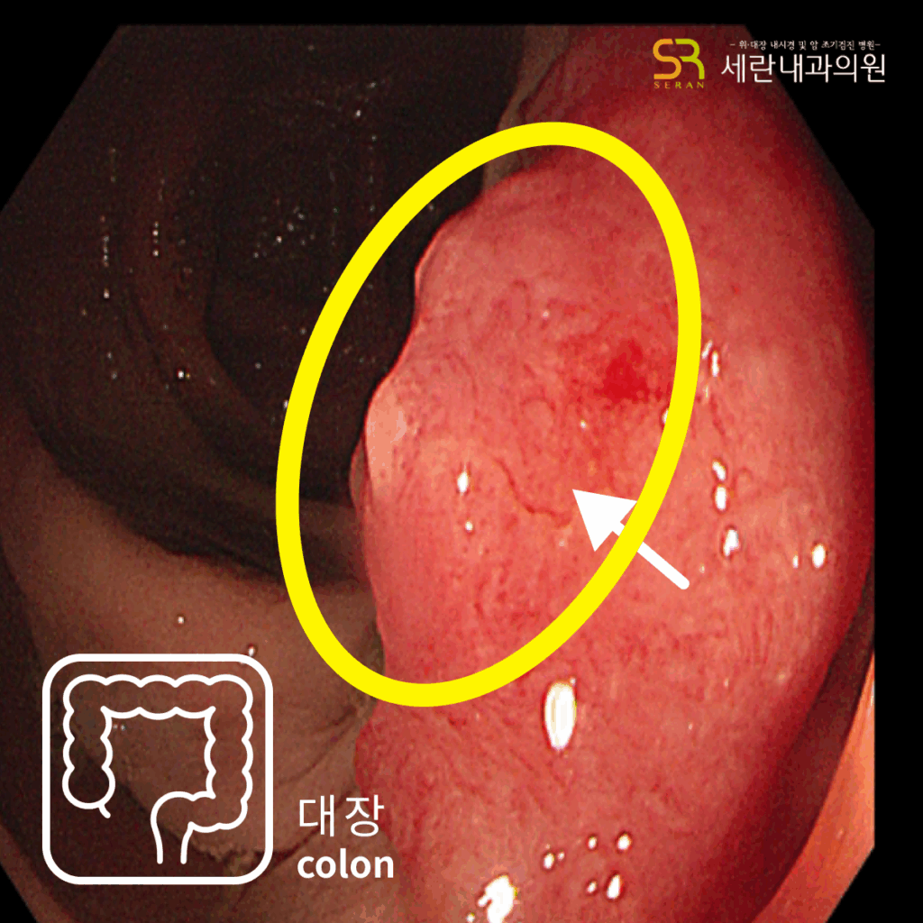대장에서 발견된 용종