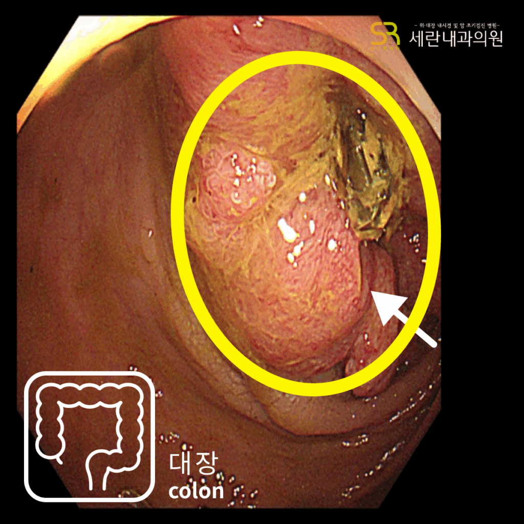 직장암 조직검사 시행 부위 근접 촬영