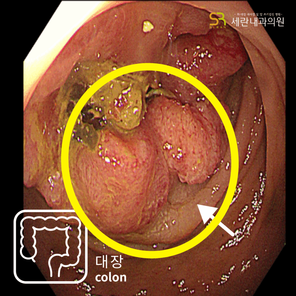 설사와 혈변, 항문 통증으로 내원했다가 직장암을 진단받은 40대 남성 사례