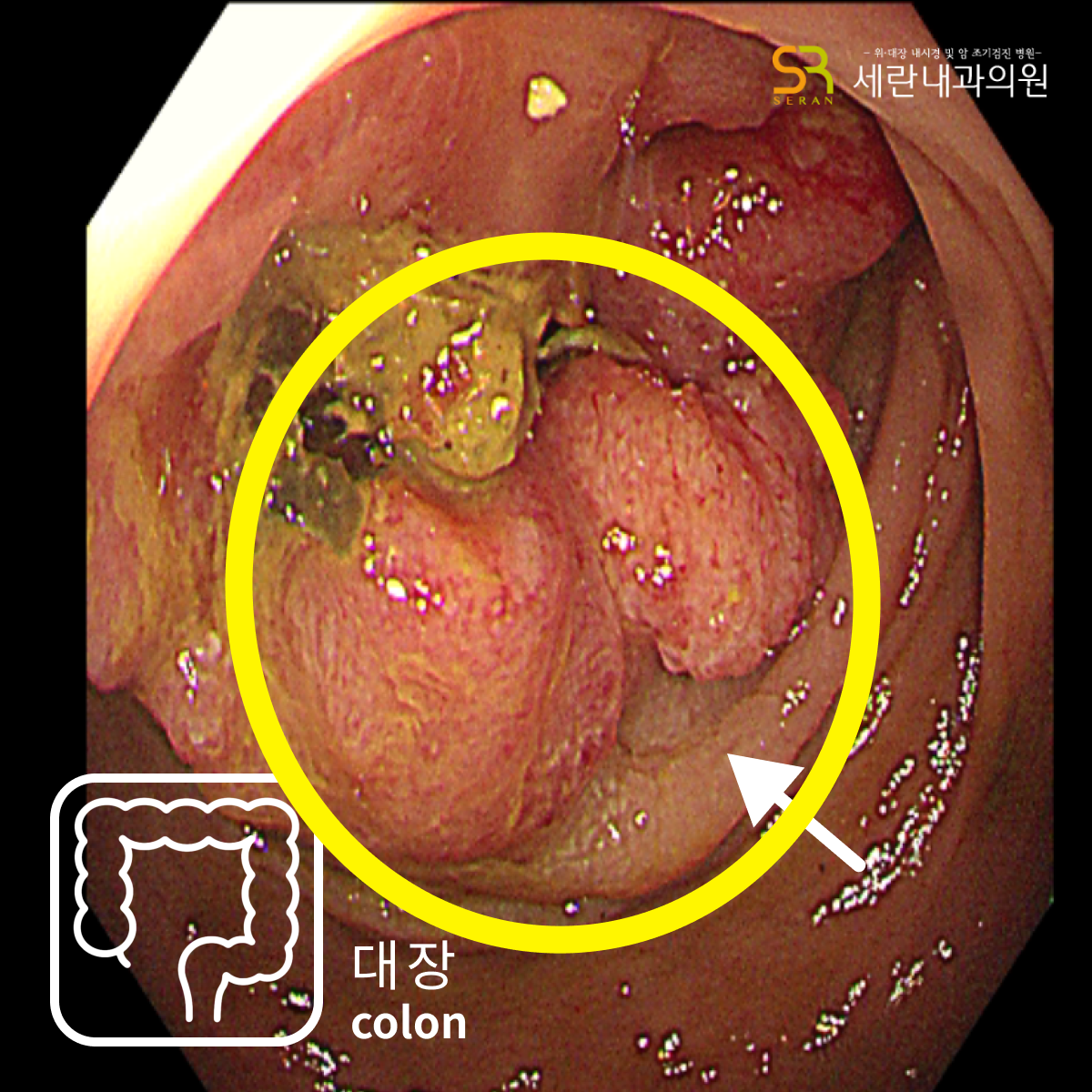 직장 상부의 궤양형 종괴 및 협착 소견