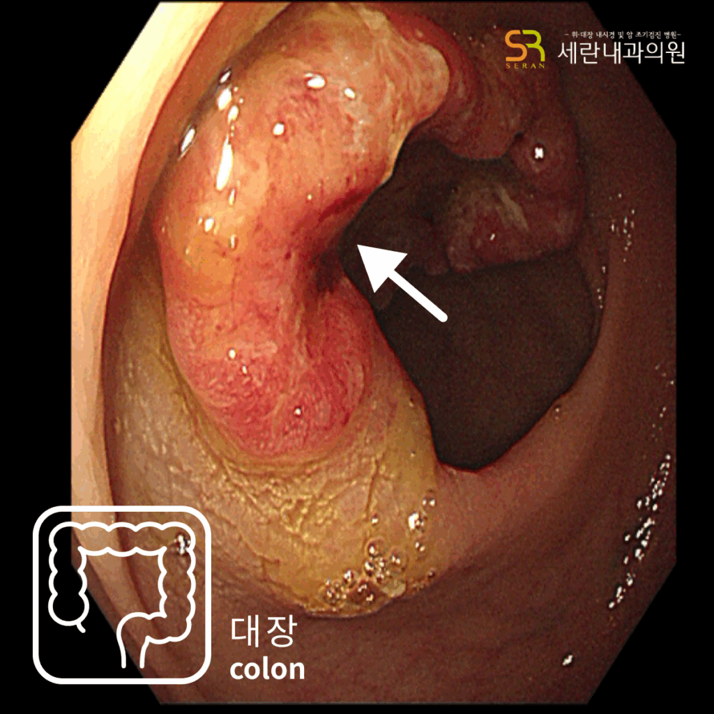 직장 상부에서 궤양형 종괴