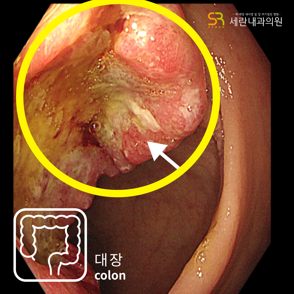 대장 용종