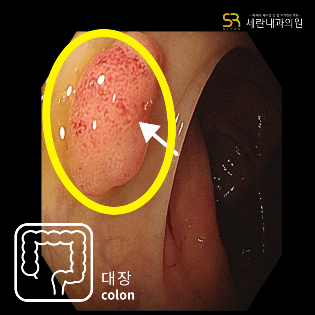 가스 차는 증상과 경미한 혈변으로 발견된 직장암 사례