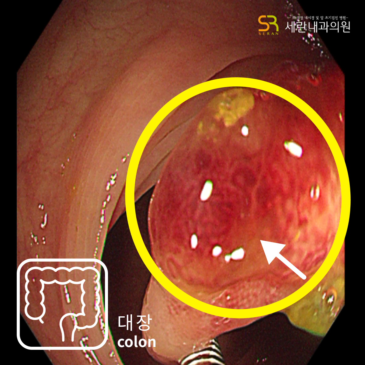 대장 용종
